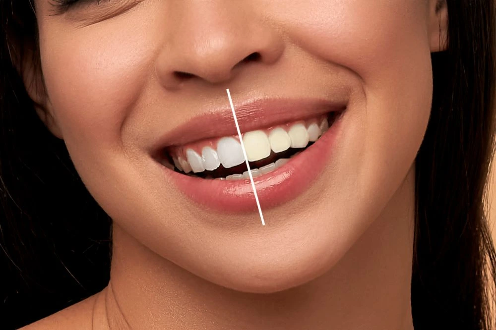 11 Effective Ways to Naturally Teeth Whitening