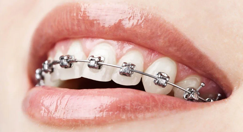 How to Find a Trusted Orthodontist in Wyndham Vale?
