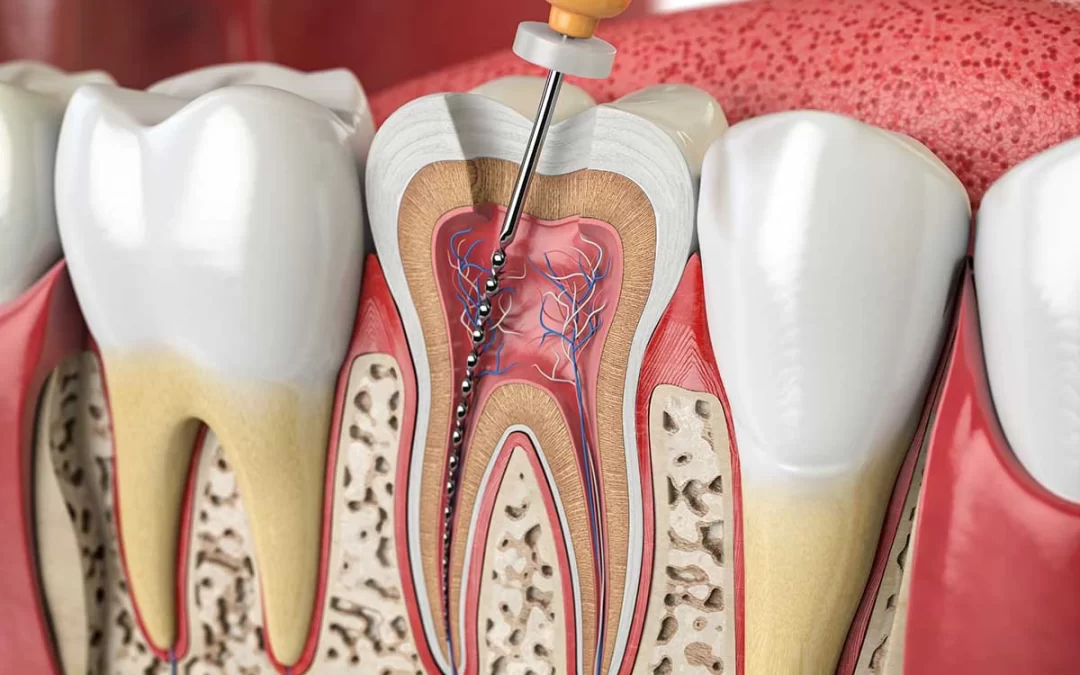 Everything You Need to Know About Root Canal Therapy in Wyndham Vale