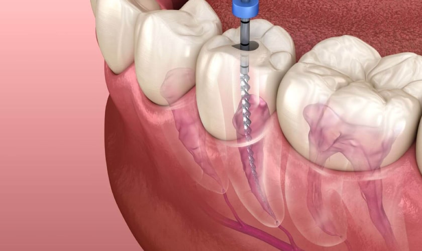 10 Warning Signs of Root Canal Treatment in Wyndham Vale