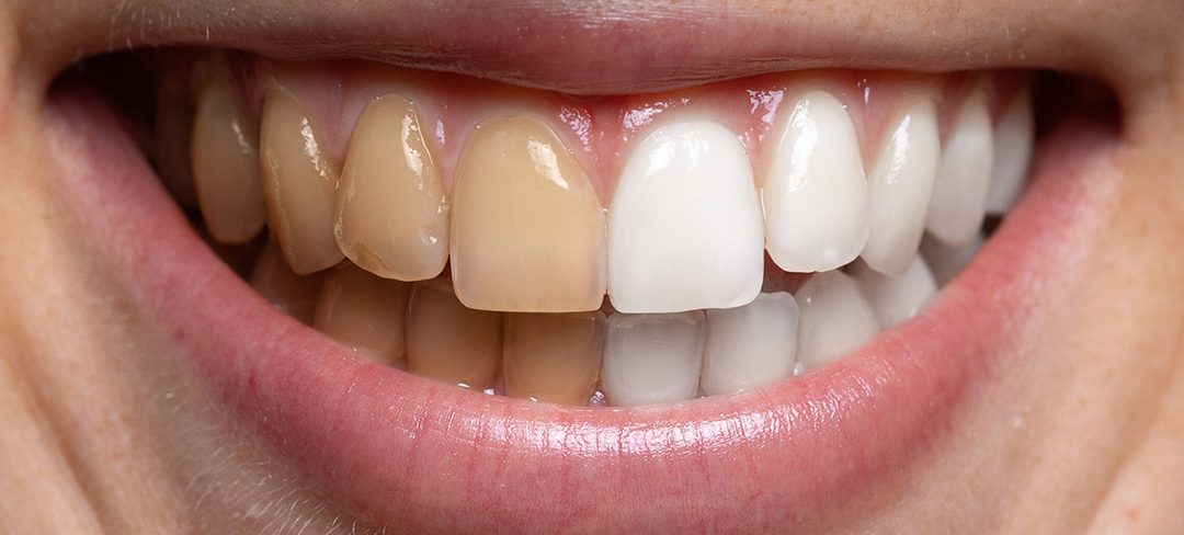 Teeth Whitening Results: How Long Will Your Smile Stay Bright?