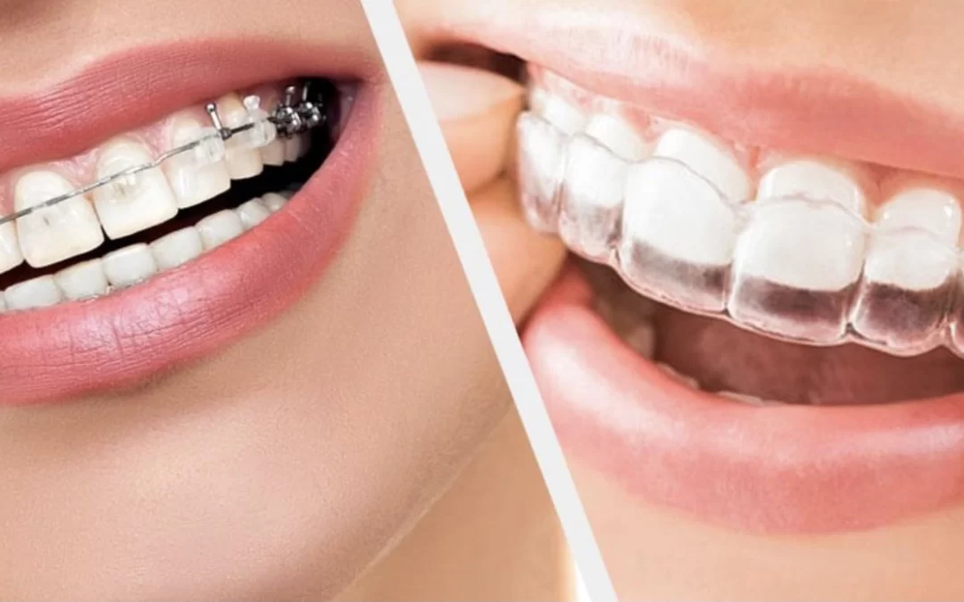 Modern Orthodontic Treatment for Adults: What You Should Know?