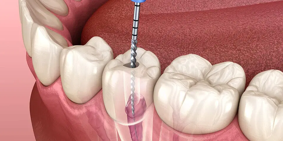 How Long Does Root Canal Treatment Usually Take?