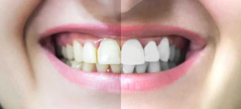 Teeth Whitening Explained: In-Clinic Treatment vs. At-Home