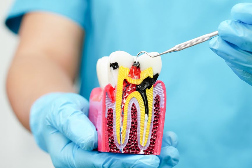 17 Pros and Cons of Painless Root Canal Treatment in Werribee
