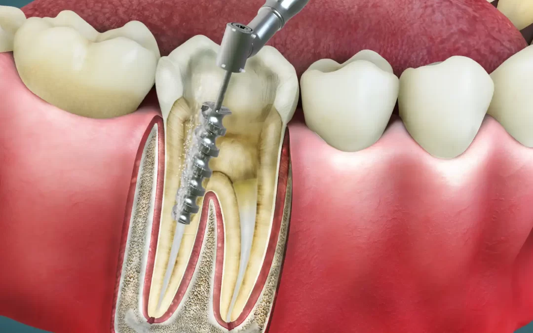 Benefit of Root Canal Treatment in Werribee: It’s Worth Considering