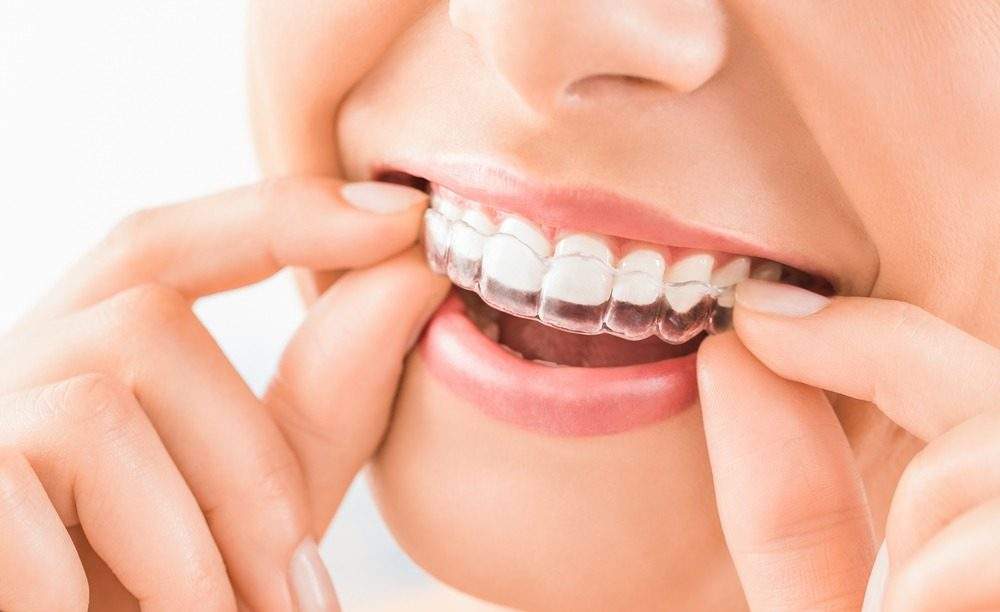 10 Myths Concerning Invisible Braces in Werribee You Should Be Able to Stop Believing