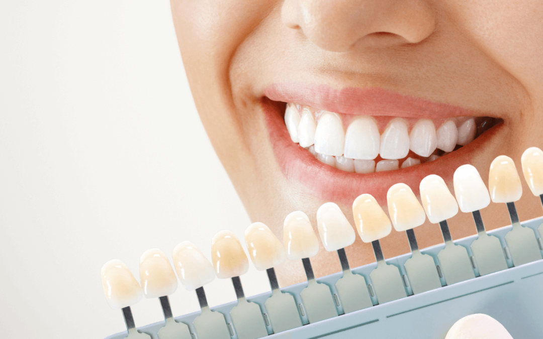 12 Things to Consider When Making a Decision to Teeth Whitening in Werribee