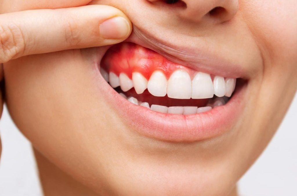 A Comprehensive Understanding Wyndham Vale Gum Disease and the Treatment Options