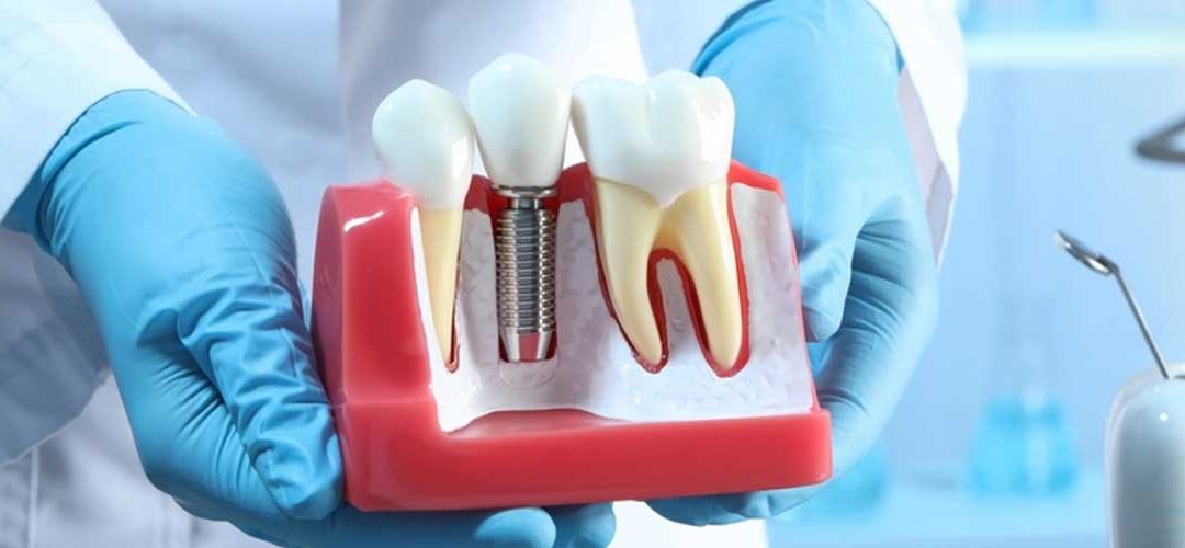 Do You Really Need a Dental Implant?