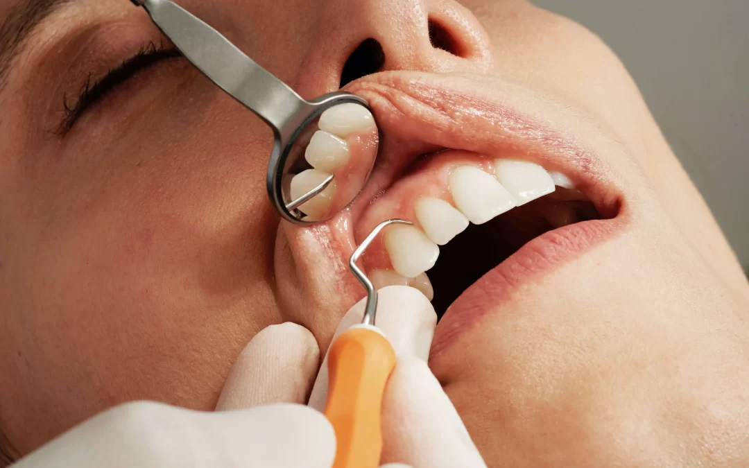 Reasons for Dental Checkups & Scale & Cleaning Are Important