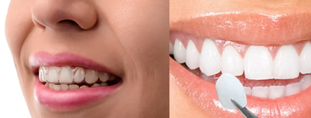 Veneers vs Crowns vs Invisalign: Which One Is Right?