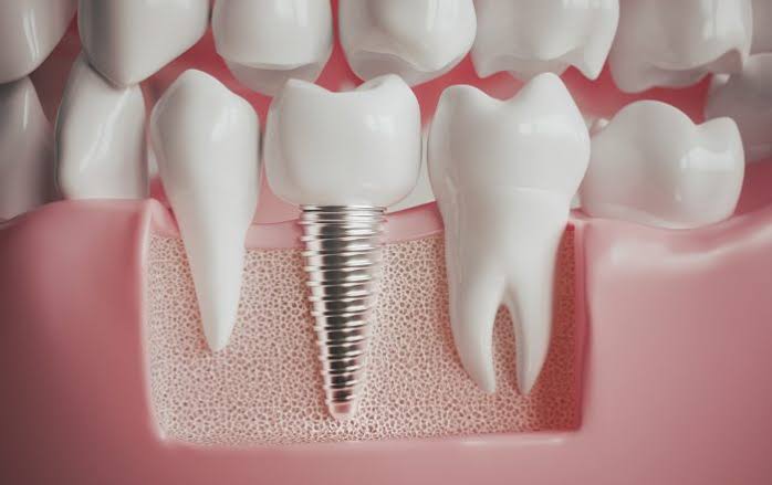 Dental Implants Wyndham Vale Explained: The Full Process, Step by Step
